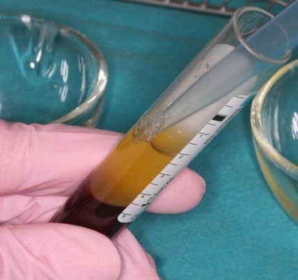 Thanks to the use of plasma PRP we are able to enhance each patient's healing capacity, inducing more tissue regeneration, quicker healing and less discomfort Thanks to the use of plasma PRP we are able to enhance each patient's healing capacity, inducing more tissue regeneration, quicker healing and less discomfort