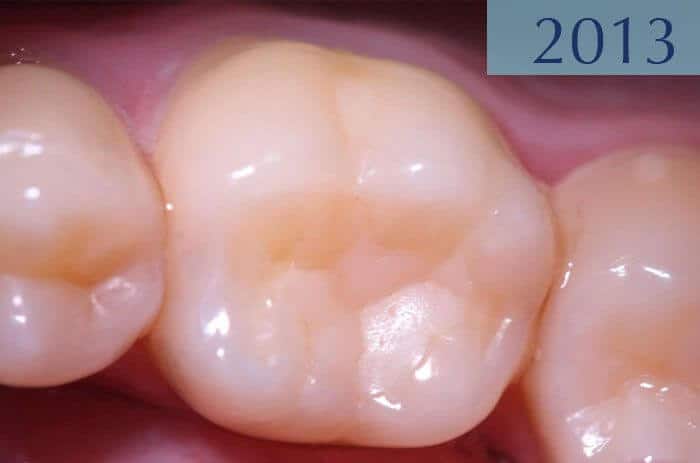 Dental filling 16 years later, performed in 1997 at Dental Clínica Padrós in a dental caries treatment Dental filling 16 years later, performed in 1997 at Dental Clínica Padrós in a dental caries treatment