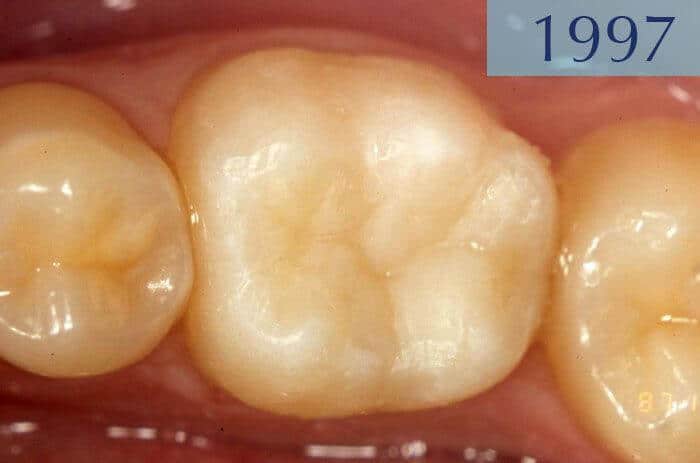 Dental filling performed in 1997 at Dental Clinic Padrós in a dental caries treatment Dental filling performed in 1997 at Dental Clinic Padrós in a dental caries treatment