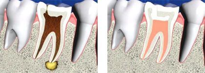 Internal view of the teeth before and after the endodontic treatment Internal view of the teeth before and after the endodontic treatment