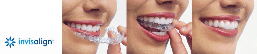 The Padrós dental clinic in Barcelona has the invisalign invisible orthodontic treatment, transparent and removable appliances The Padrós dental clinic in Barcelona has the invisalign invisible orthodontic treatment, transparent and removable appliances