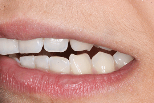 Bruxism is the third most common sleep disorder. One in four people suffer from it. Grinding or tightening of the teeth causes mandibular pain, headache, etc. Bruxism is the third most common sleep disorder. One in four people suffer from it. Grinding or tightening of the teeth causes mandibular pain, headache, etc.