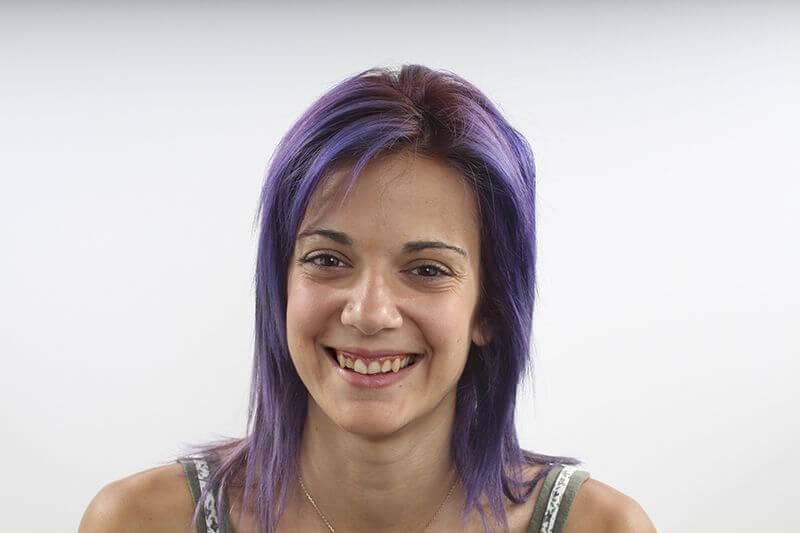 Before treatment of composite dental veneers Before treatment of composite dental veneers