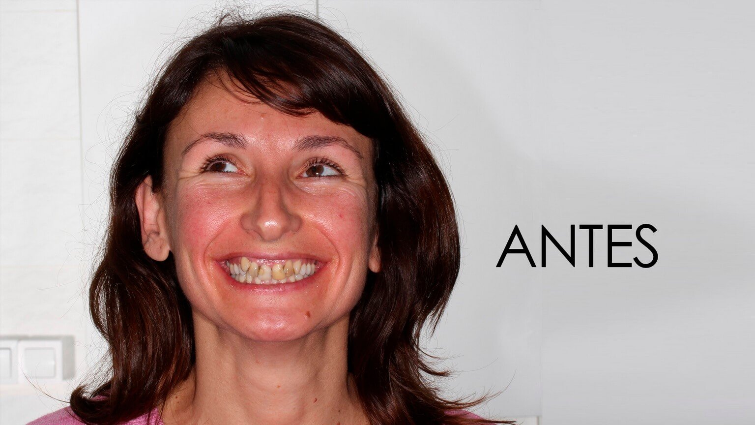 Before the study of dental aesthetics and orthodontic treatment Before the study of dental aesthetics and orthodontic treatment