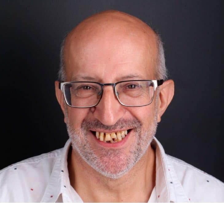 Before dental implants threatment Before dental implants threatment