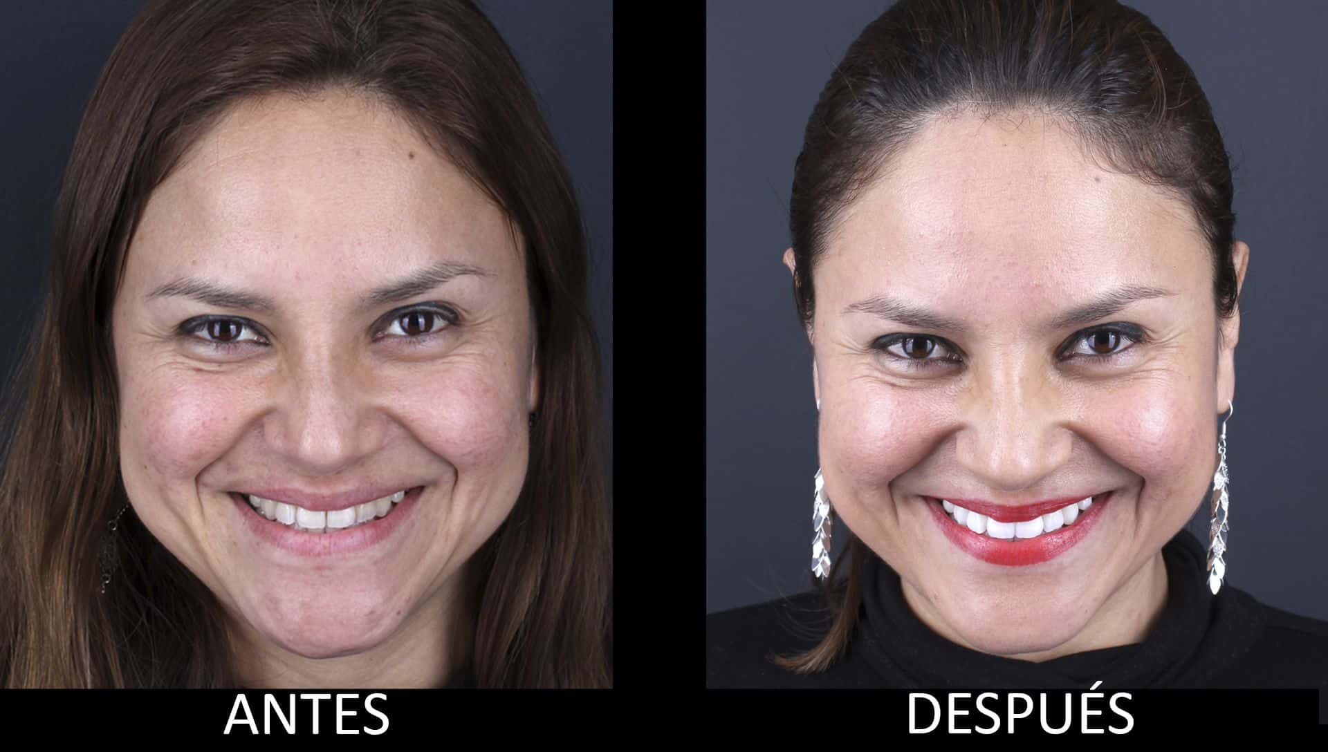 Before and after teeth whitening treatment Before and after teeth whitening treatment