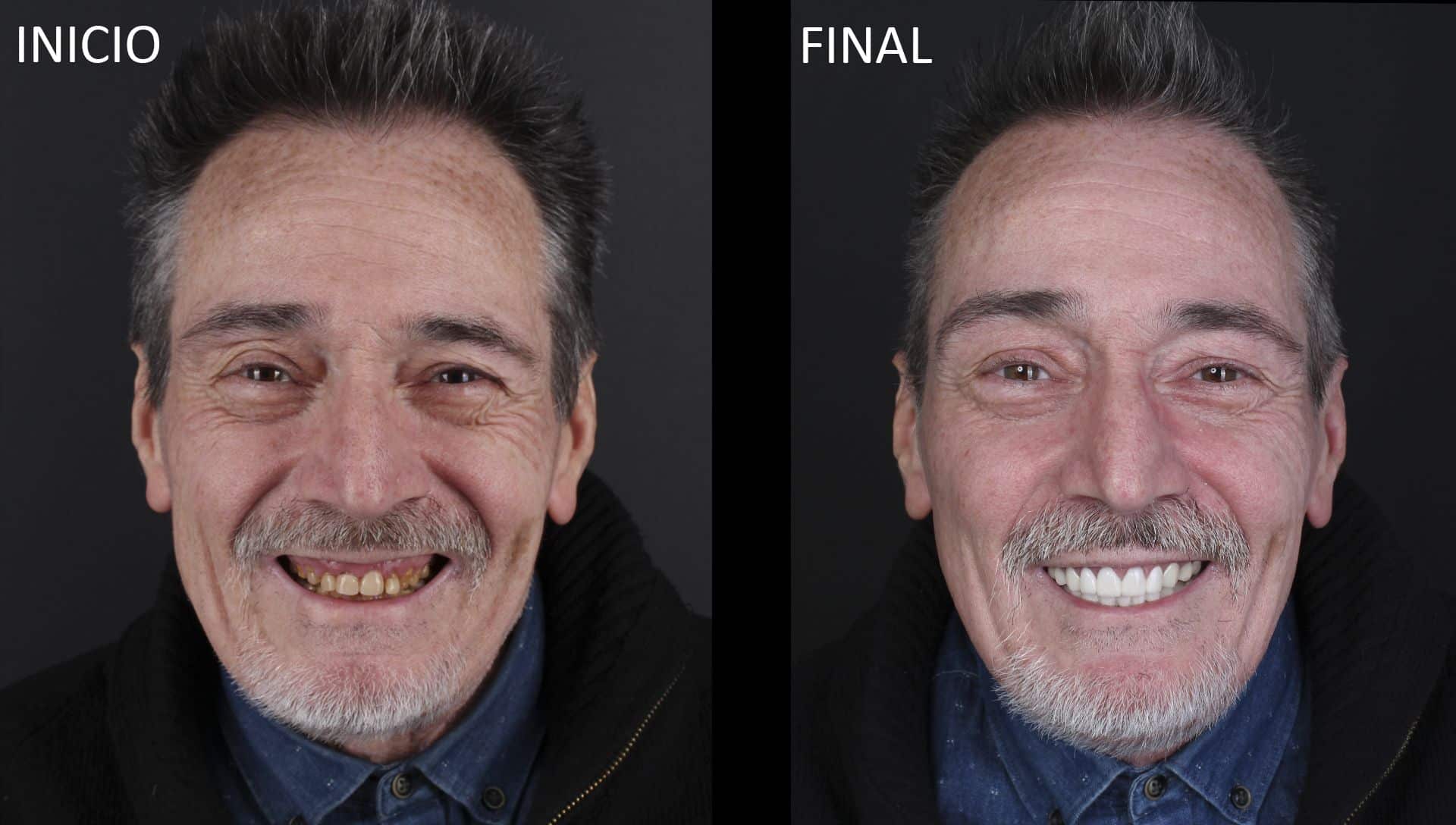 Joaquin after & before cosmetic dentistry treatment Joaquin after & before cosmetic dentistry treatment