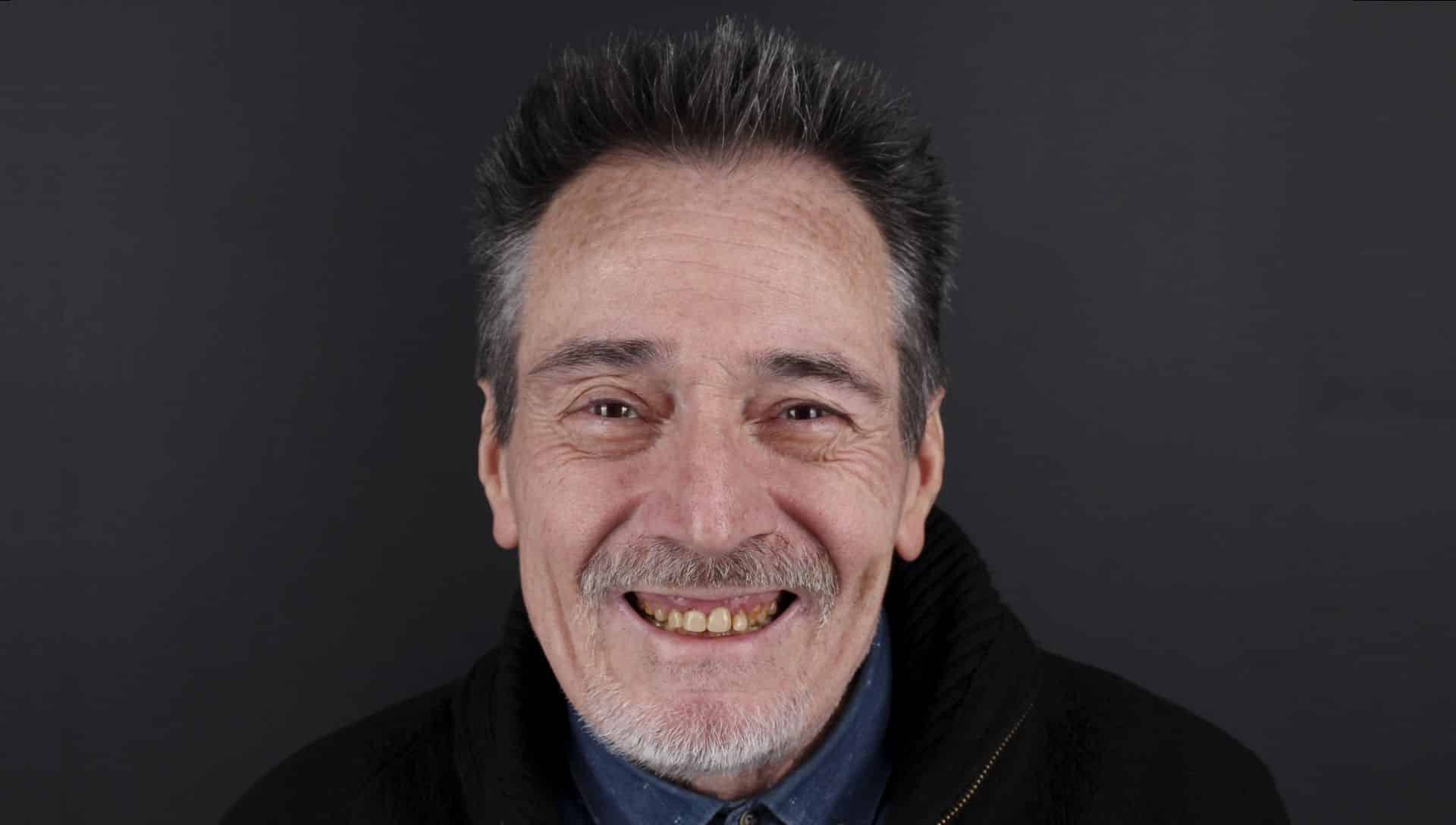 Joaquin before cosmetic dentistry treatment Joaquin before cosmetic dentistry treatment