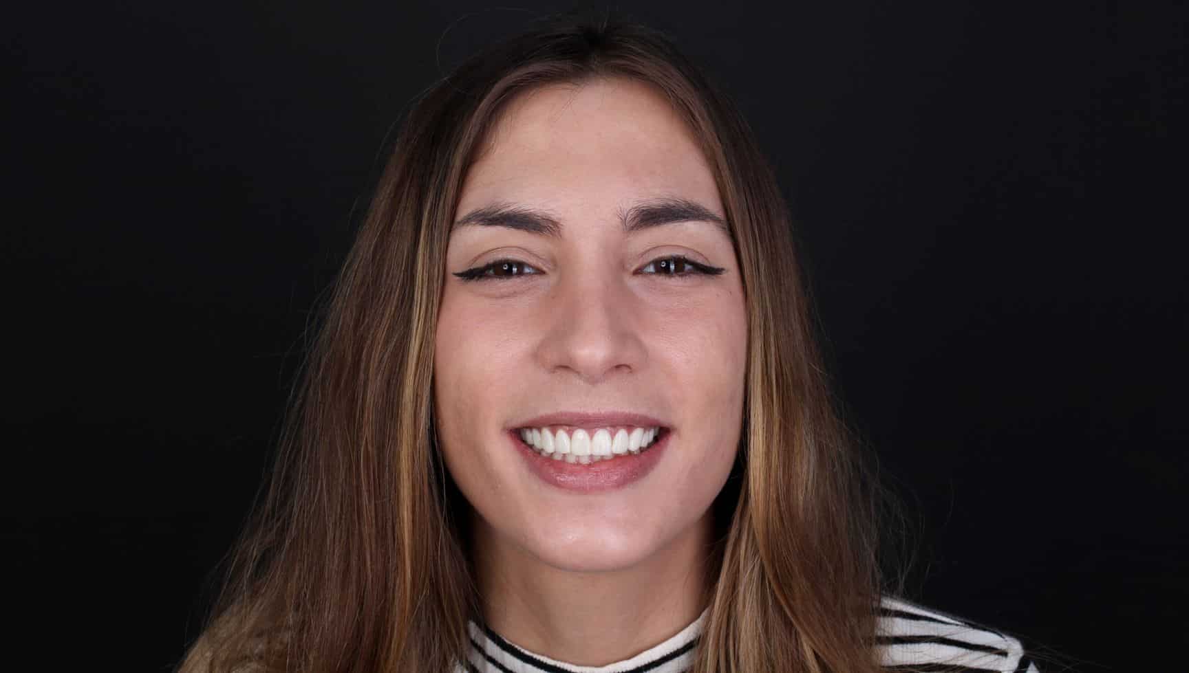After cosmetic dentistry treatment After cosmetic dentistry treatment