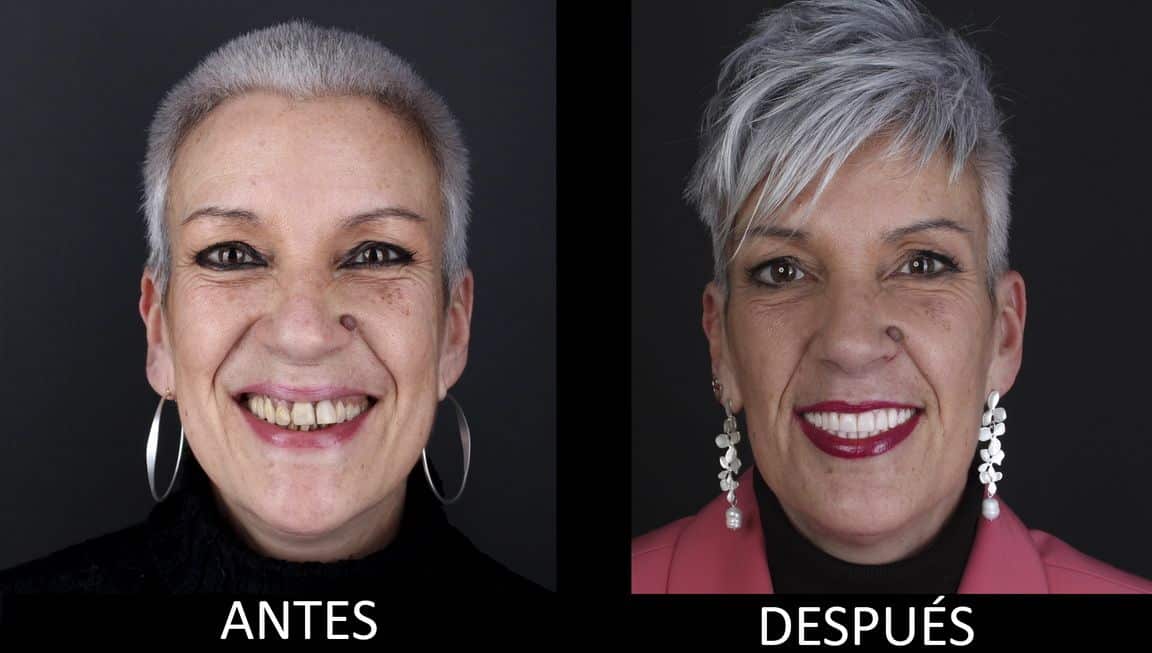 Before and after dental implant treatment Before and after dental implant treatment