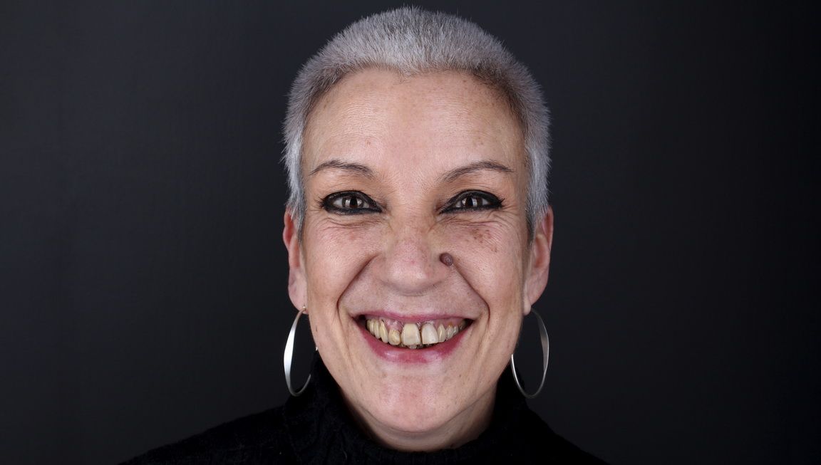 Before dental implant treatment Before dental implant treatment