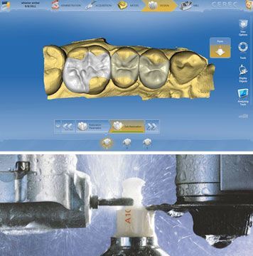 The Cerec 3D CAD/CAM dental system means we can fabricate dental restorations with a precision of fit down to 30 microns.