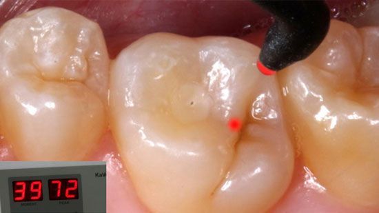 The Diagnodent laser caries diagnosis system facilitates early detection of hidden tooth damage