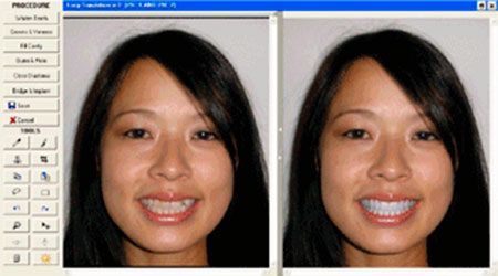Dental aesthetics. Computer simulation of the change in your smile means you can see how the general appearance of your face will improve Dental aesthetics. Computer simulation of the change in your smile means you can see how the general appearance of your face will improve
