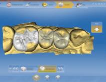 Images of a real case in dental clinic Padrós with the system CEREC CAD-CAM. With the use of design software we can improve the design and creation of dental restorations, especially dental prostheses including crowns, veneers, bridges, implants and orthodontic appliances Images of a real case in dental clinic Padrós with the system CEREC CAD-CAM. With the use of design software we can improve the design and creation of dental restorations, especially dental prostheses including crowns, veneers, bridges, implants and orthodontic appliances
