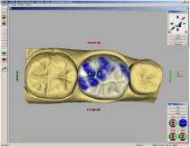 Images of a real case in dental clinic Padrós with the system CEREC CAD-CAM. With the use of design software we can improve the design and creation of dental restorations, especially dental prostheses including crowns, veneers, bridges, implants and orthodontic appliances Images of a real case in dental clinic Padrós with the system CEREC CAD-CAM. With the use of design software we can improve the design and creation of dental restorations, especially dental prostheses including crowns, veneers, bridges, implants and orthodontic appliances