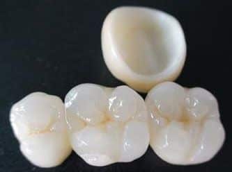 With the use of CAD-CAM design software we can improve the design and creation of dental restorations, especially dental prostheses including crowns, veneers, bridges, implants and orthodontic appliances With the use of CAD-CAM design software we can improve the design and creation of dental restorations, especially dental prostheses including crowns, veneers, bridges, implants and orthodontic appliances