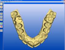 Images of a real case in dental clinic Padrós with the system CEREC CAD-CAM. With the use of design software we can improve the design and creation of dental restorations, especially dental prostheses including crowns, veneers, bridges, implants and orthodontic appliances Images of a real case in dental clinic Padrós with the system CEREC CAD-CAM. With the use of design software we can improve the design and creation of dental restorations, especially dental prostheses including crowns, veneers, bridges, implants and orthodontic appliances