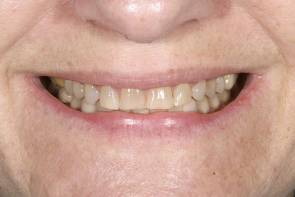 Before treatment of porcelain veneers Before treatment of porcelain veneers