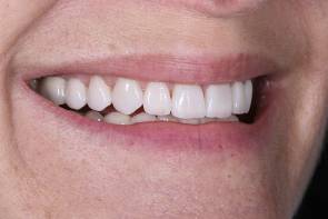 Final result after treatment of porcelain veneers Final result after treatment of porcelain veneers