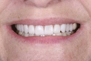 After treatment of porcelain veneers After treatment of porcelain veneers