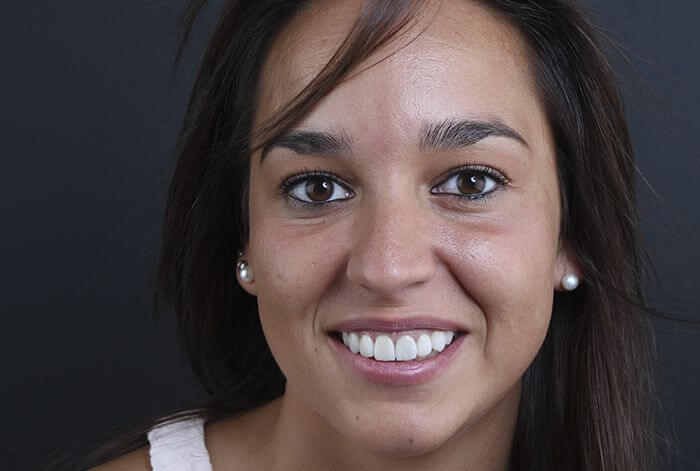 After treatment of porcelain veneers After treatment of porcelain veneers