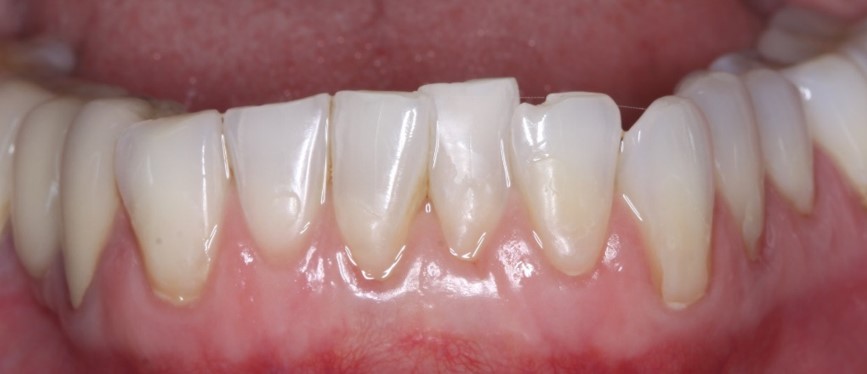 After treatment of receding gums using the Pinhole technique