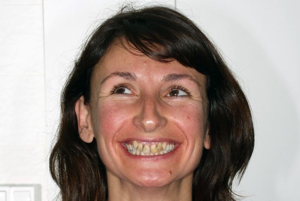 Abans del tractament d'ortodoncia