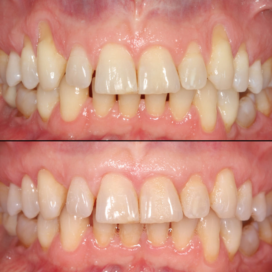 Caso dental Salva: tratamiento de encías retraídas Pinhole