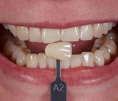 Dental whitening treatment. Padrós dental clinic, dentist in Barcelona