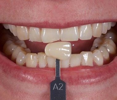 Abans del tractament de blanquejament dental