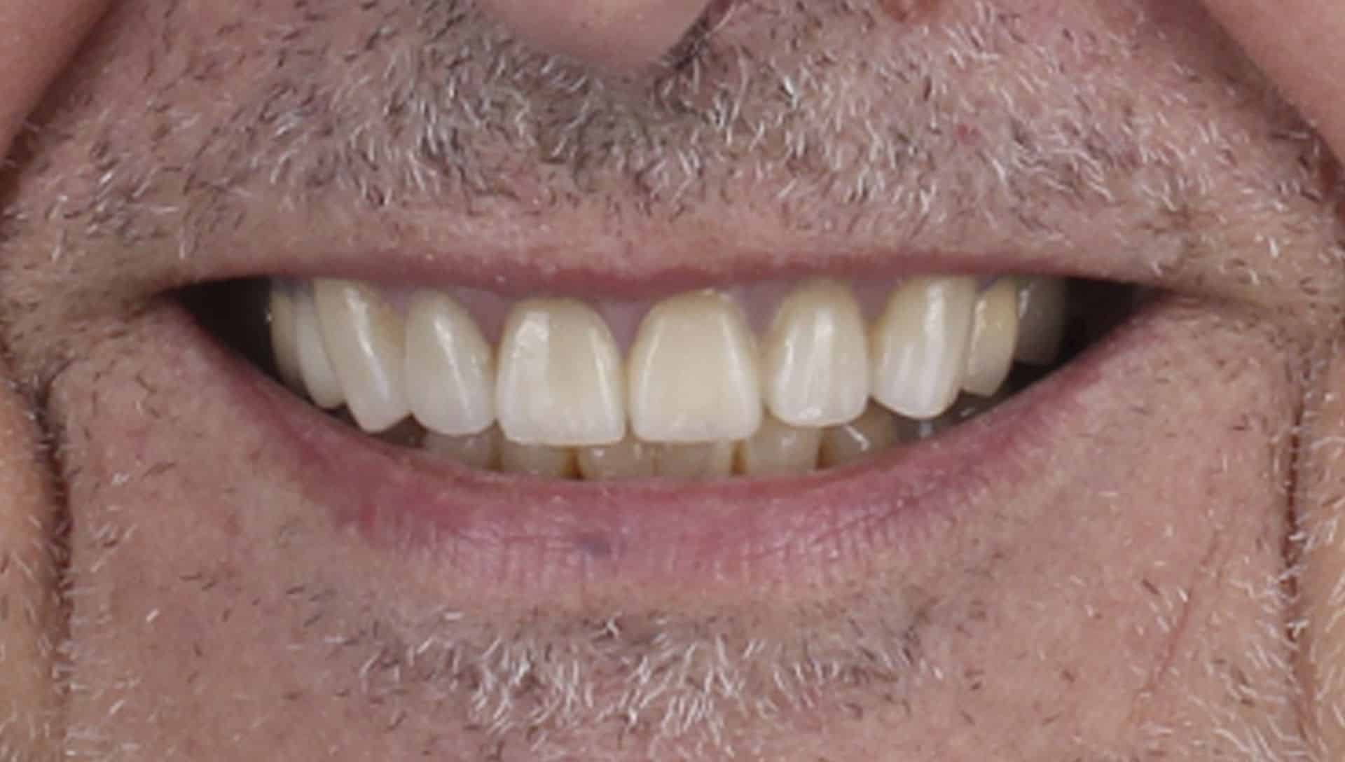 After dental implant treatment