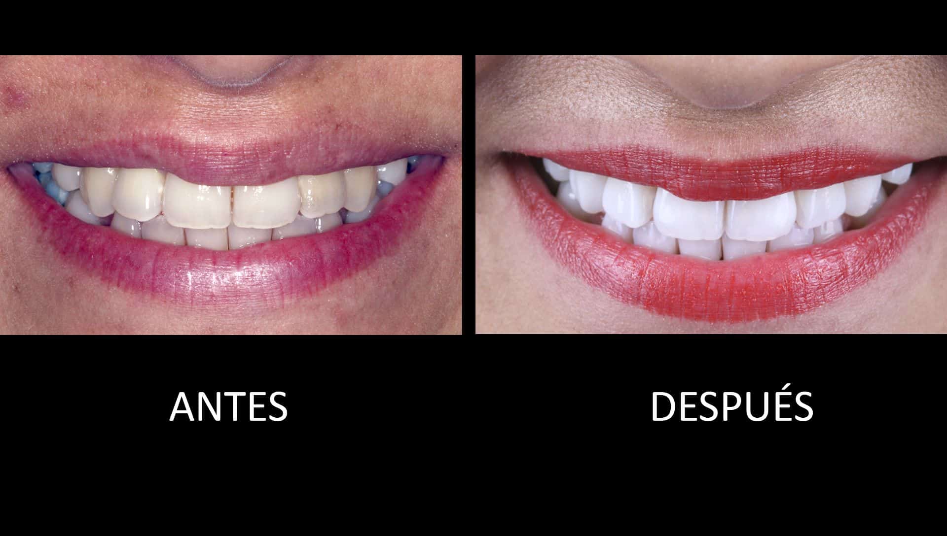 Antes y después del tratamiento de blanqueamiento dental