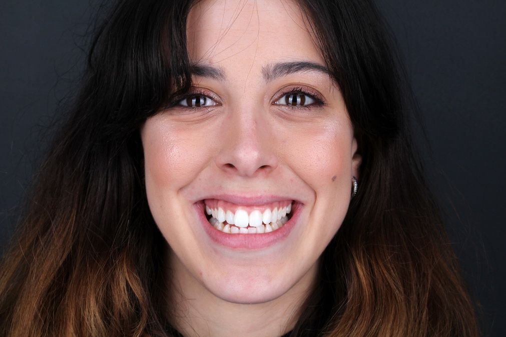 Jessica dental case. After orthodontics and teeth whitening. Padrós dental clinic, your dentist in Barcelona.
