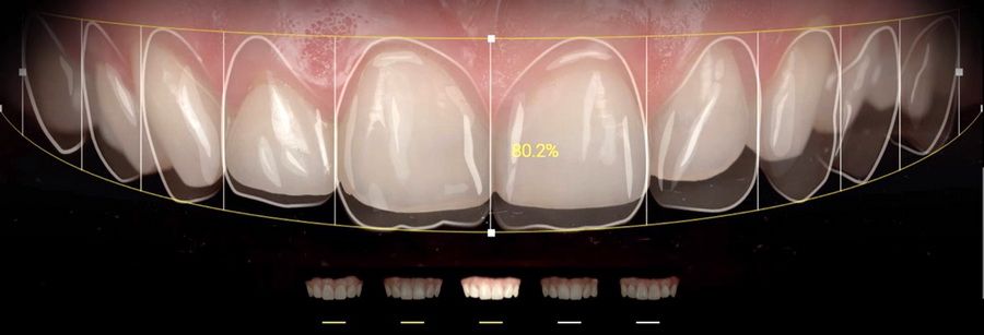 Applications like Smile Cloud, Ivosmile, DSDapp or Snap Dental help us in the calculation of proportions, choice of shape, color and position of the teeth in your new smile and allow us to carry out digital simulations to help us choose your new smile.