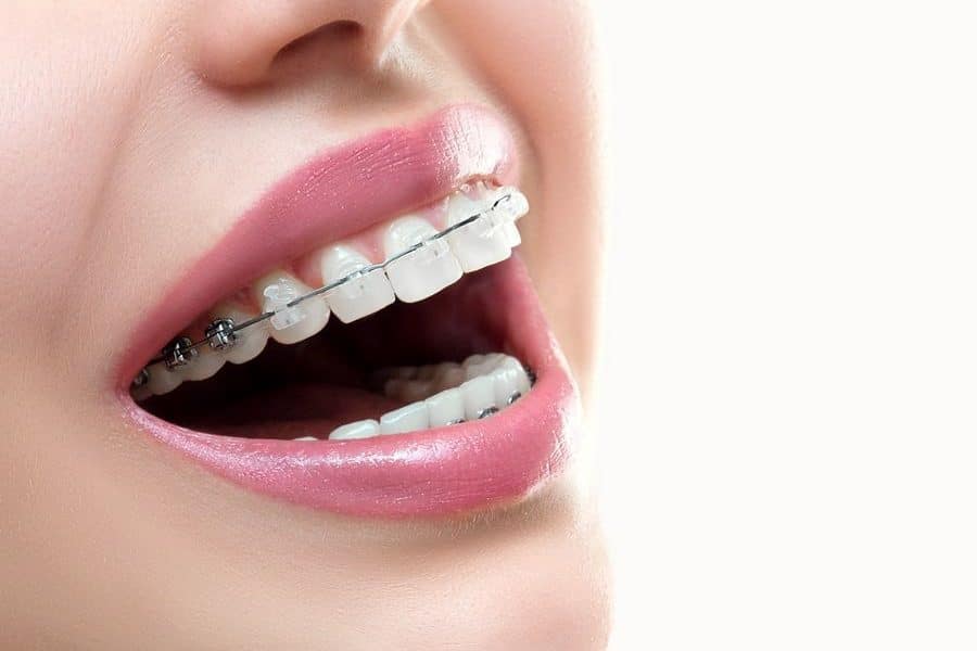 We have the Damon orthodontic brackets treatment at Padrós dental clinic, your dentist in Barcelona