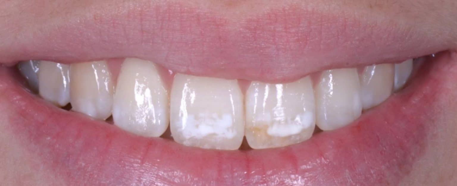 Icon Opalustre removes fluorosis stains Clínica Dental Padrós