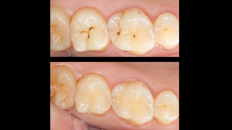 Dental air abrasion is a minimally invasive method of treating caries, with no discomfort, vibrations or high-pitched sounds