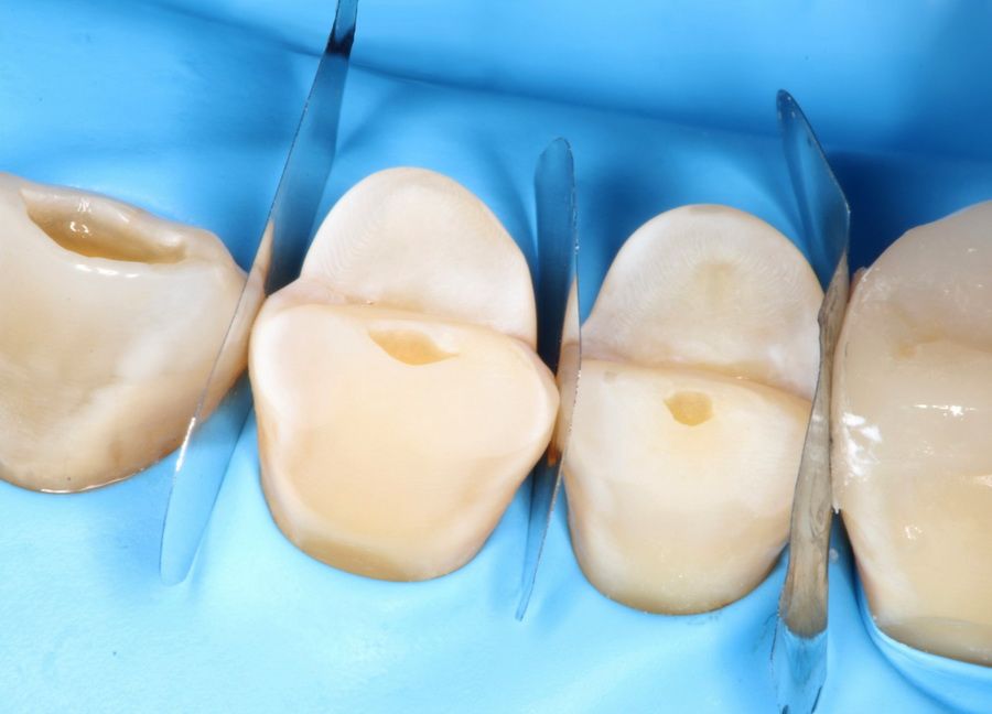 Case of dental wear treated in our dental clinic in Barcelona