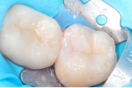 Amalgam removal treatment, old metal fillings in Padrós dental clinic. Your dentist in Barcelona