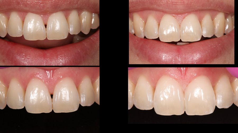 Tooth reconstruction treatment in Padrós dental clinic. Your dentist in Barcelona