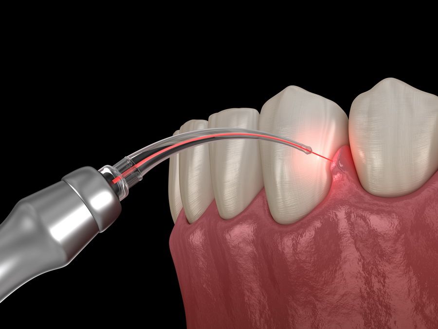 Periodontal treatment of the gums for diseases such as gingivitis and periodontitis in the dental clinic Padrós in Barcelona