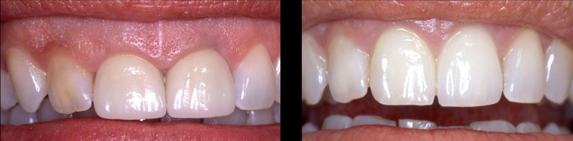 Aesthetic treatment of the gums, gingival smile or excess gum. Padrós Dental Clinic, dentist in Barcelona