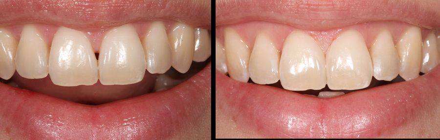 Aesthetic treatment for receding gums. Padrós Dental Clinic, dentist in Barcelona