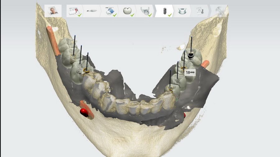 Our Simplant 3D radiology system allows us to program cases of dental implant treatments with great accuracy. We can perform virtual surgeries, prepare templates, know the density of the bone at each point, etc.