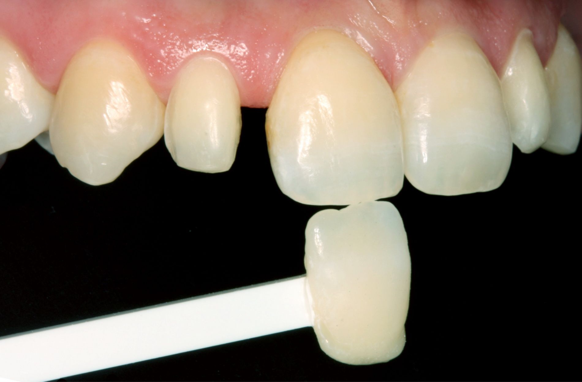Before treatment with the CEREC 3D system incorporating CAD-CAM technology