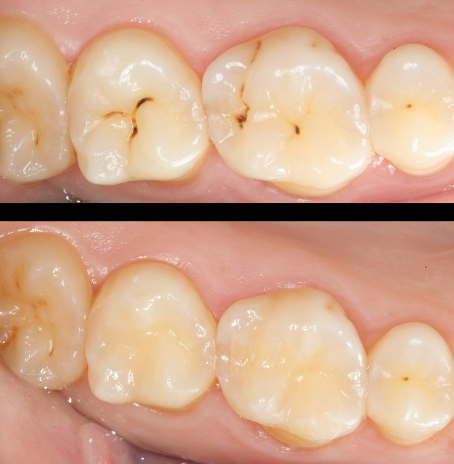 Caries prevention, diagnosis and treatment - Clínica Dental Padrós