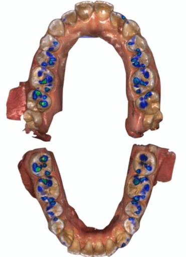 Digital reproduction obtained through the new intraoral scanner PrimeScan