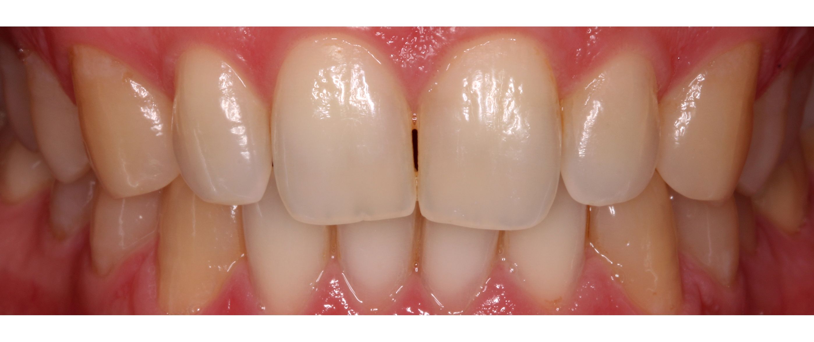 Dental whitening treatment. Padrós dental clinic, dentist in Barcelona