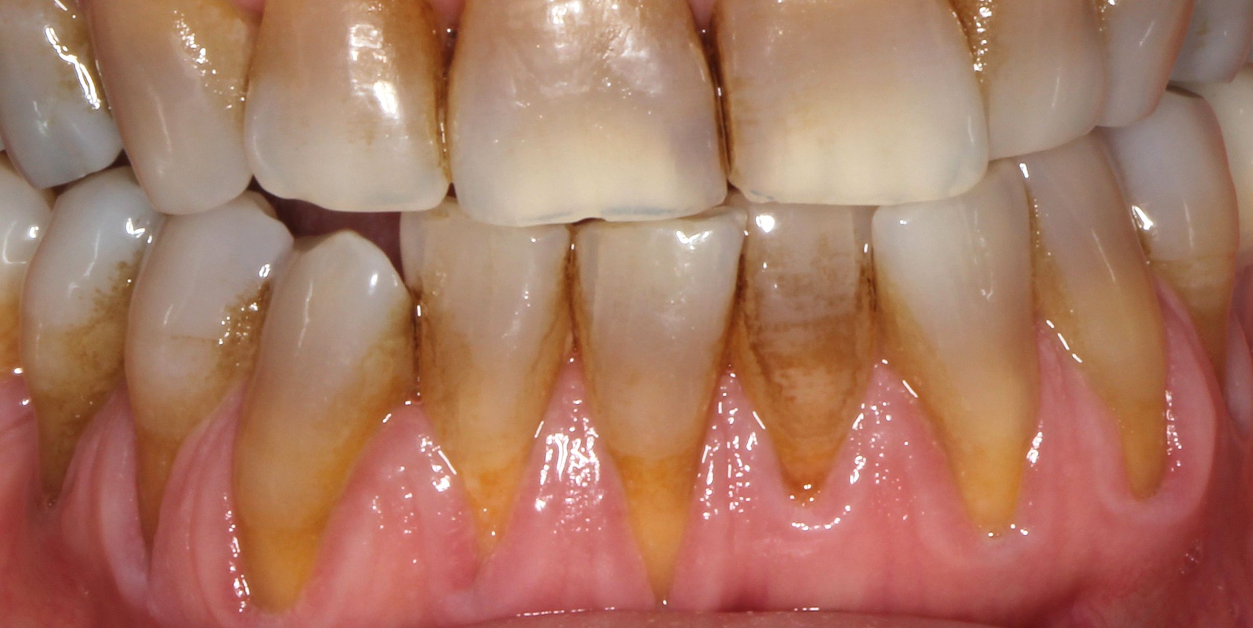 Before treatment of receding gums using the Pinhole technique